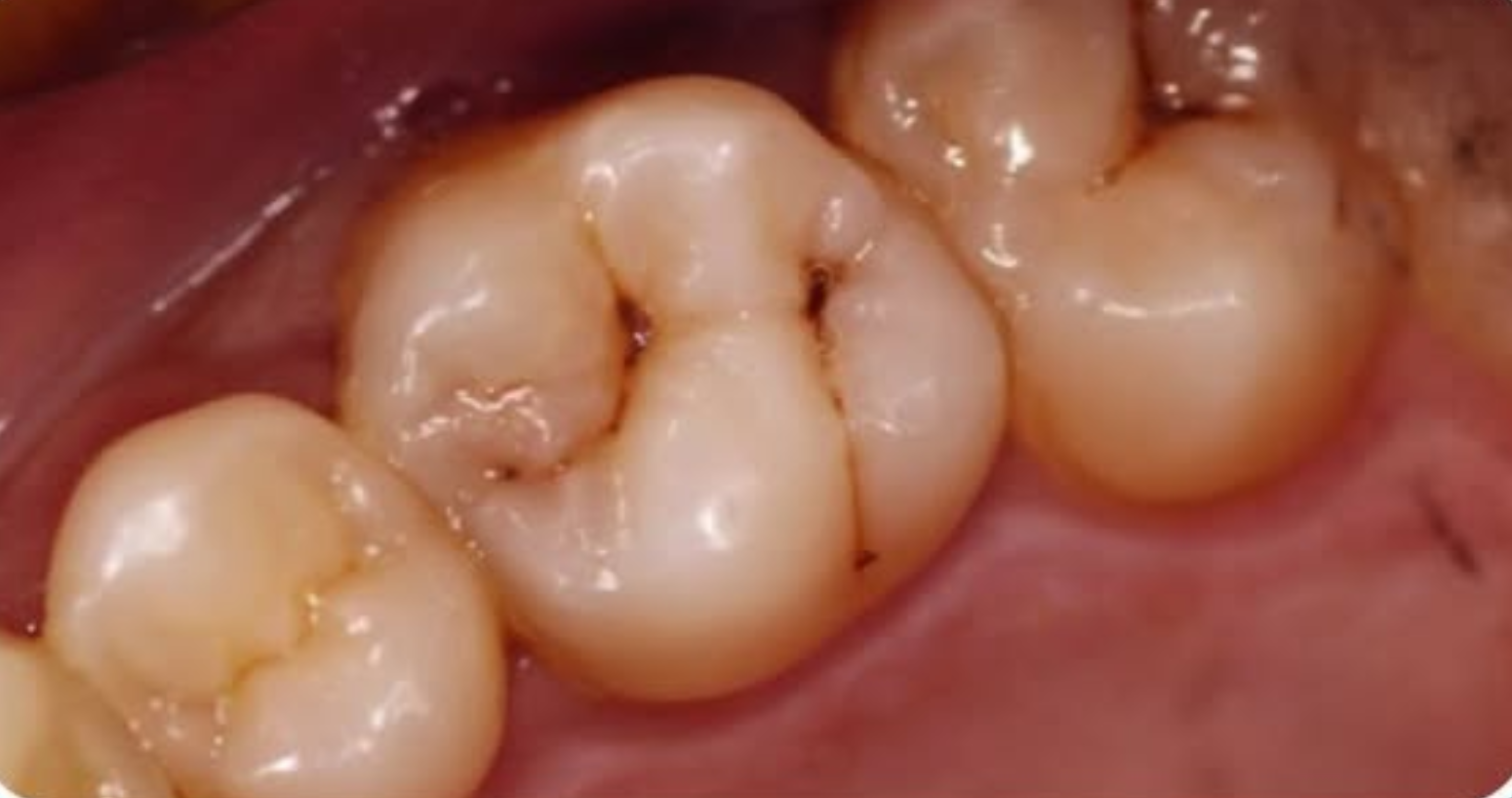 قبل العلاج - تقويم الأسنان