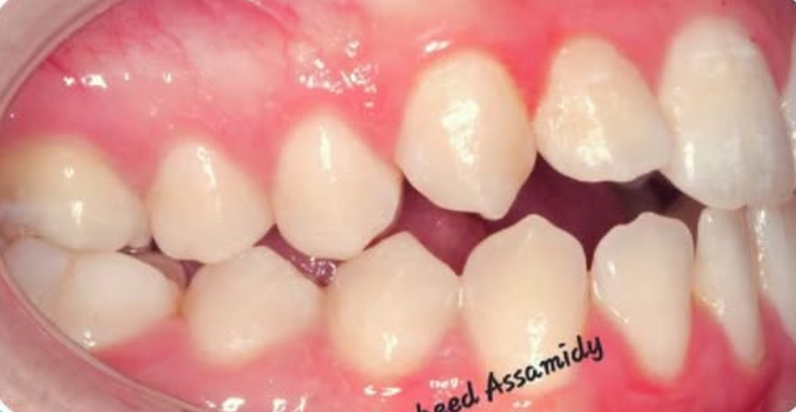 قبل العلاج - تيجان الزركونيوم
